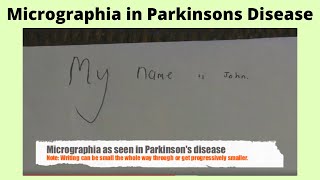 Micrographia in Parkisons disease [upl. by Fennell]