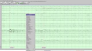 Left temporal slowing and epileptiform activity [upl. by Butta]