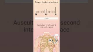 patent ductus arterioususPDA and auscultation of heart sound and heart murmur [upl. by Ahsatam]