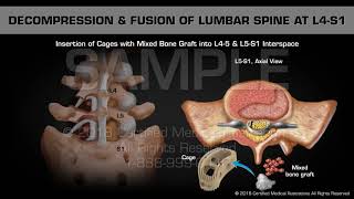 Decompression amp Fusion of Lumbar Spine at L4S1 [upl. by Cassandra]