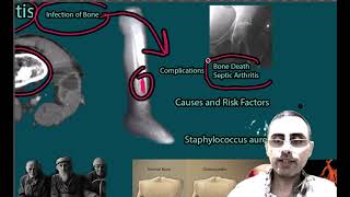 Osteomyelitis  Symptoms Causes risk factors Treatment [upl. by Brenza720]