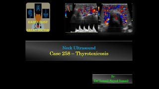 Ultrasound Case 258  Thyrotoxicosis [upl. by Ybba]