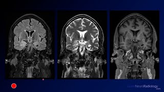 Neuroradiology Board Review  Brain Tumors  Case 13 [upl. by Atirak534]