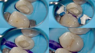 build up Class II Composite restoration for premolar [upl. by Julita862]