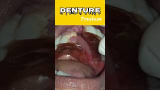 Denture Fracture denture false tooth [upl. by Ahsikad426]