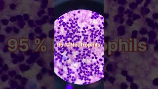 pleural pleuraleffusion blood cbc fluid giemsastain [upl. by Malita247]