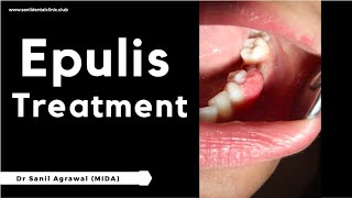 Gingival Enlargement  Epulis  Treatment  Dr Sanil Agrawal [upl. by Adnilasor240]