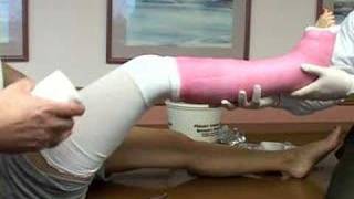 application of a long leg cast [upl. by Nnahgiel]