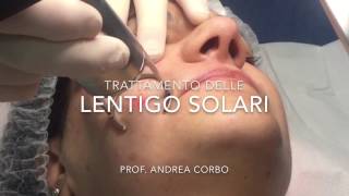 Lentigo Solari  Trattamento con Laser frazionato CO2 [upl. by Vaughn]