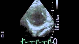 Dobutamine Stress Echocardiogram in apical myocardial infarction [upl. by Nichol]