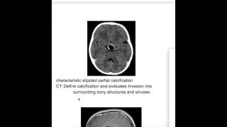 Craniopharangioma [upl. by Umont]