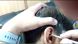 Removing Overflowed Ear wax  ear wax removal asmrearwax satisfying [upl. by Neerac580]