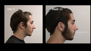 Minoxidil Beard Growth  3 Month Transformation  Timelapse BEFORE and AFTER [upl. by Weiss]