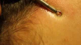 Blackhead extraction  forehead zit [upl. by Ayotnom]