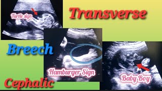 Transverse Breech amp Cephalic Baby In Uterus Genderreveal  Anterior Posterior Placenta Baby Gender [upl. by Briano]