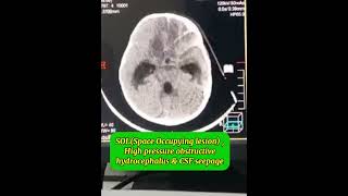 Posterior fossa SOL Brain tumor CT scan High pressure obstructive non communicating hydrocephalus [upl. by Yeneffit]