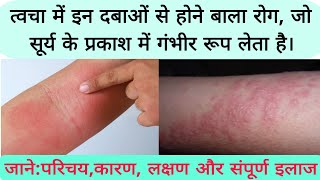 photosensitive eruption eczema disease फोटोसुग्रहित विस्फोट छाजन रोग का कारण लक्षण और संपूर्ण इलाज [upl. by Ahen]