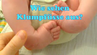 Wie sehen Klumpfüsse aus Ein paar Tage nach der Geburt [upl. by Mellie]