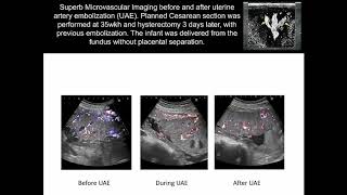 UOG Video clip use of ultrahighfrequency probe for the diagnosis of placenta accreta spectrum [upl. by Bernita]