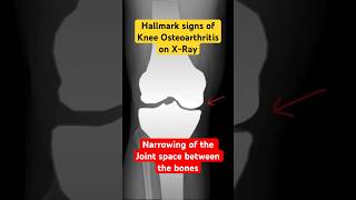 Joint space narrowing on Xray of knee with Osteoarthritis health radiology kneepain [upl. by Ethelyn844]