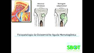 Osteomielite Aguda Hematogênica e Artrite Séptica Dr José Luís Amim Zabeu [upl. by Nrojb289]