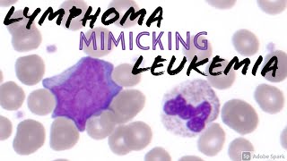 Circulating Diffuse Large Bcell Lymphoma Cell Mimicking Acute Myeloid Leukemia AML Blast Hematology [upl. by Inoy]