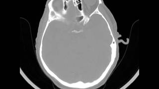 Bilateral Craniotomy for subdural hematomas  Head CT bone windows [upl. by Aicrag]