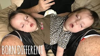 Conjoined Twins Are A Medical Miracle  BORN DIFFERENT [upl. by Agarhs]