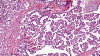 Papillary Thyroid Carcinoma  Histopathology [upl. by Wetzell]