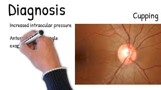 Glaucoma  Explained easy Mechanism symptoms treatment prognosis [upl. by Ecnerewal998]