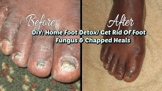 DIY Home Foot Detox How To Get Rid Of Foot Fungus [upl. by Connett434]