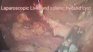 Laparoscopic Hydatid Cyst SurgeryLaparoscopicSurgery HydatidCyst MinimallyInvasiveSurgeonSkills [upl. by Eddy890]