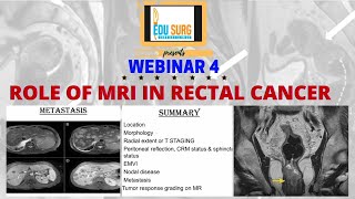 MRI for rectal cancer  rectal cancer staging  understanding MRI rectum  radiology masterclass [upl. by Screens]