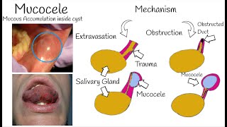 Oral Mucocele  The Most Common Mucosal lesion  Mucous Cyst Symptoms Causes amp Treatment [upl. by Yerocaj]