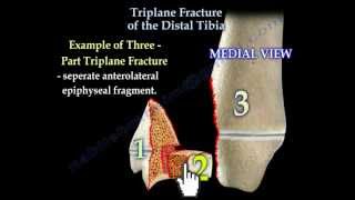 Triplane Fracture Of The Distal Tibia  Everything You Need To Know  Dr Nabil Ebraheim [upl. by Ahseirej]