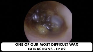 ONE OF OUR MOST DIFFICULT EAR WAX REMOVALS  EP 62 [upl. by Ahsiuqel453]