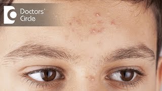 Are there side effects with long term bactrim tablets taken for Scalp Acne  Dr Rasya Dixit [upl. by Sutelc711]