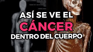 ¿Cómo es que se detecta y se ve el cáncer dentro del cuerpo  PET CT Scanner [upl. by Dnartreb]