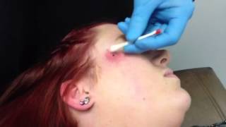 Dermal Piercing on cheek [upl. by Nylime]