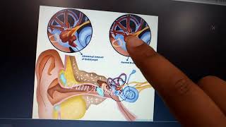 MENNIERS DISEASE complete explanation with all important stuff and diagrams part 1 [upl. by Cynthia]