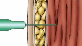 Pharmacology IM Absorption [upl. by Dow]