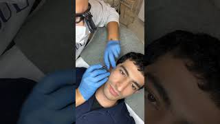 Yanak İğneli Epilasyon electrolysis electrolysishairremoval epilasyon iğnelilazer [upl. by Inej]