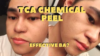 TCA DIY SKIN CHEMICAL PEEL  RESULTS AND BEFORE AFTER IS IT EFFECTIVE [upl. by Ahselef]