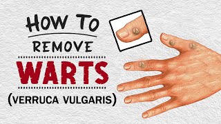 How to Remove Warts using Natural Treatments  Home Remedies for Warts Removal [upl. by Huston861]