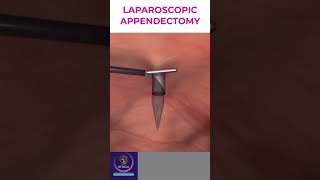 Laparoscopic Appendectomy  Appendicitis Treatment [upl. by Nosiddam]