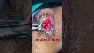 EYELID CYST CHALAZION surgery [upl. by Bettine]