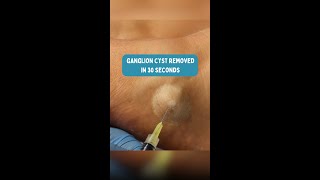 Watch this ganglion cyst get drained ganglioncyst podiatrist [upl. by Goddard528]