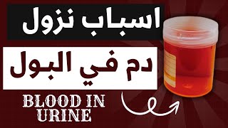 27اسباب نزول الدم في البول Hematuria amp Hemoglobinuria وتفسير العلاقة بين الدم والشريط والميكروسكوب [upl. by Branca]