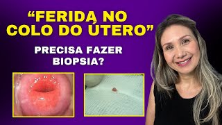 Precisa fazer biopsia da quotferida do colo do útero [upl. by Andreana]