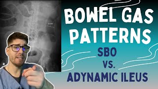 SBO vs Adynamic Ileus Learn the 369 rule to read bowel gas patterns on Xrays [upl. by Adla559]